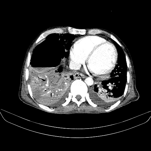 File:Abdominal collection due to previous cecal perforation (Radiopaedia 80831-94320 Axial C+ portal venous phase 7).jpg