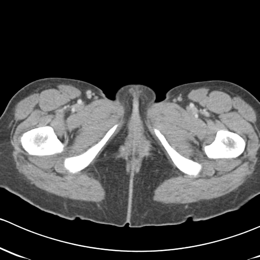File:Abdominal desmoid tumor (Radiopaedia 41007-43740 Axial C+ portal venous phase 80).png
