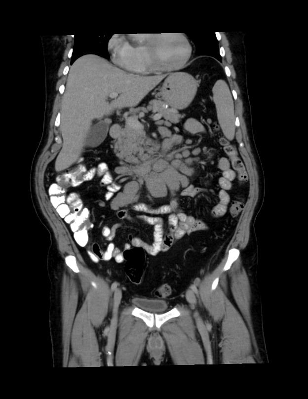 Abdominal lymphoma - with sandwich sign (Radiopaedia 53486-59492 C+ portal venous phase 35).jpg