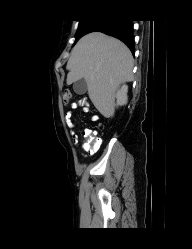 Abdominal lymphoma - with sandwich sign (Radiopaedia 53486-59492 Sagittal C+ portal venous phase 64).jpg