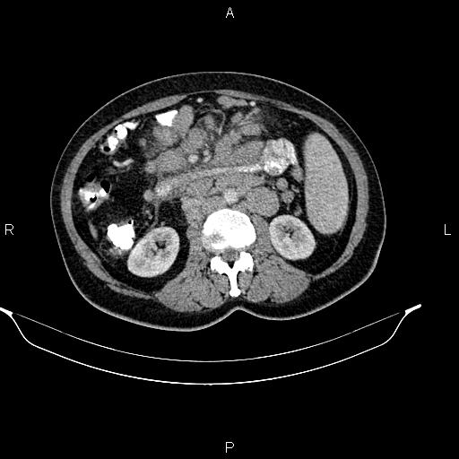 File:Abdominal lymphoma with sandwich sign (Radiopaedia 84378-99704 Axial C+ portal venous phase 28).jpg
