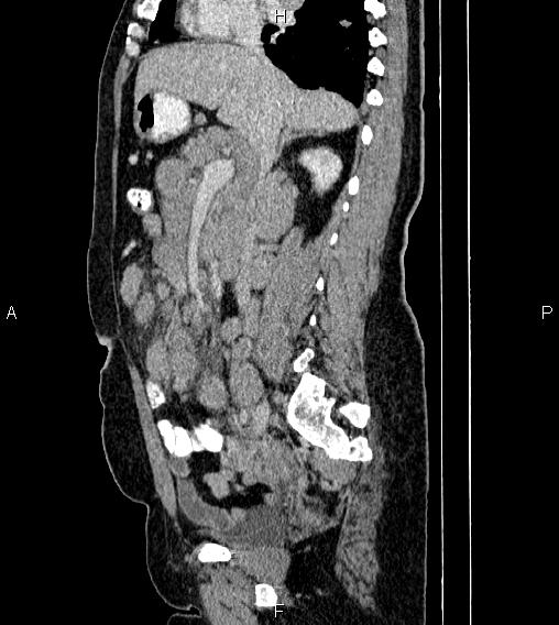 File:Abdominal lymphoma with sandwich sign (Radiopaedia 84378-99704 Sagittal C+ portal venous phase 36).jpg