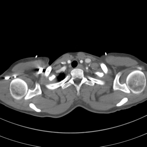 File:Abdominal multi-trauma - devascularised kidney and liver, spleen and pancreatic lacerations (Radiopaedia 34984-36486 Axial C+ arterial phase 10).png