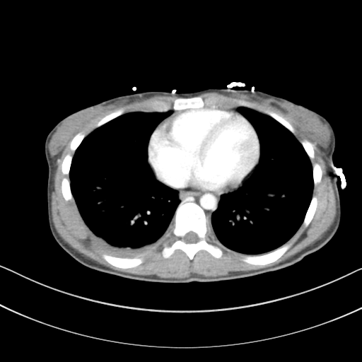 Abdominal multi-trauma - devascularised kidney and liver, spleen and pancreatic lacerations (Radiopaedia 34984-36486 Axial C+ portal venous phase 1).png