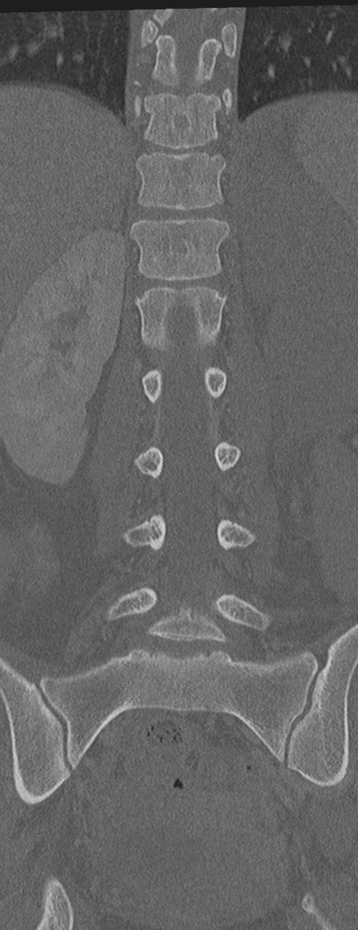 Abdominal multi-trauma - devascularised kidney and liver, spleen and pancreatic lacerations (Radiopaedia 34984-36486 Coronal bone window 38).png