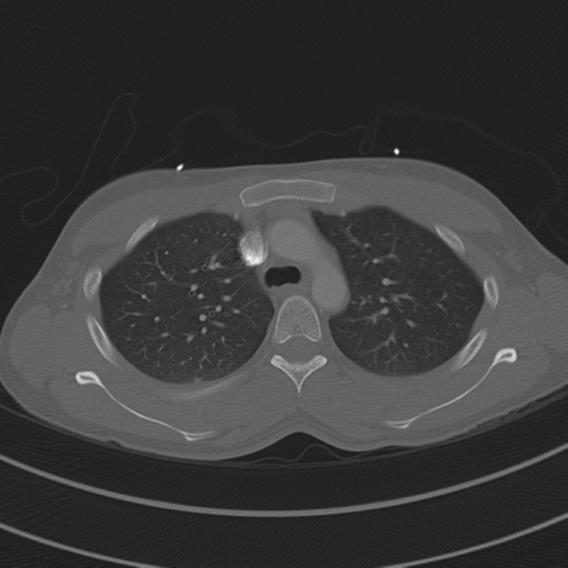 File:Abdominal multi-trauma - devascularised kidney and liver, spleen and pancreatic lacerations (Radiopaedia 34984-36486 I 27).png