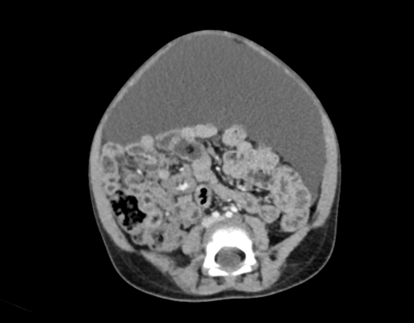 Abdominal premesenteric cystic lymphangioma (Radiopaedia 82995-97350 Axial C+ portal venous phase 39).jpg