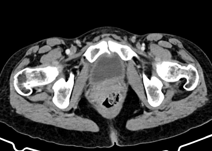 Abdominal wall and retroperitoneal tuberculosis (Radiopaedia 88137-104729 Axial C+ portal venous phase 190).jpg