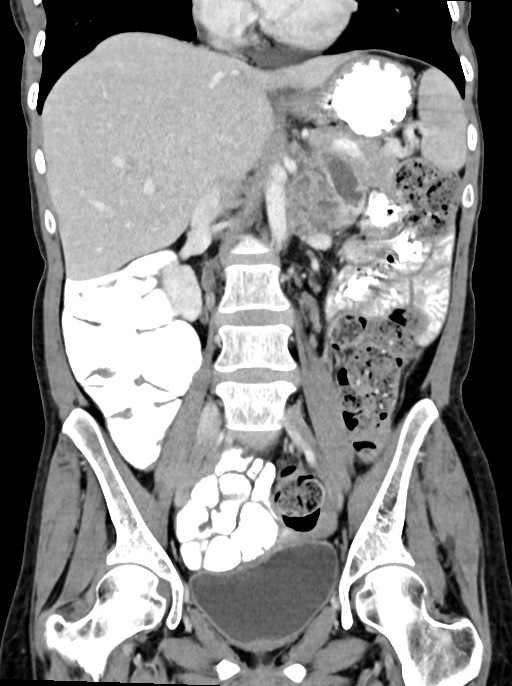 Abdominal wall and retroperitoneal tuberculosis (Radiopaedia 88137-104729 Coronal C+ portal venous phase 52).jpg