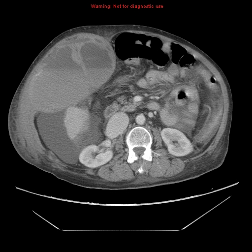 File:Abdominal wall hematoma (Radiopaedia 9427-10112 Axial C+ portal venous phase 46).jpg