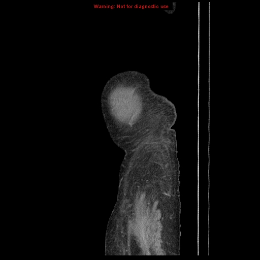 Abdominal wall hematoma (Radiopaedia 9427-10112 Sagittal C+ portal venous phase 5).jpg