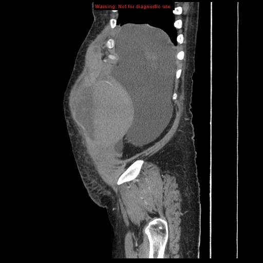 Abdominal wall hematoma (Radiopaedia 9427-10112 Sagittal C+ portal venous phase 93).jpg