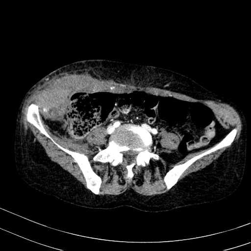 Abdominal wall hematoma with active bleeding (Radiopaedia 83915-99117 Axial renal cortical phase 83).jpg