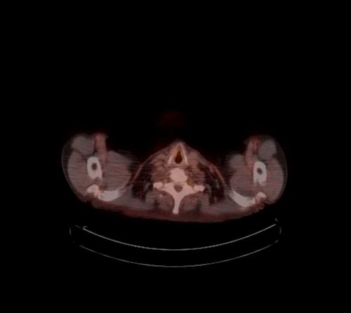Abdominal wall metastasis from colorectal carcinoma (Radiopaedia 31016-31719 C 132).jpg