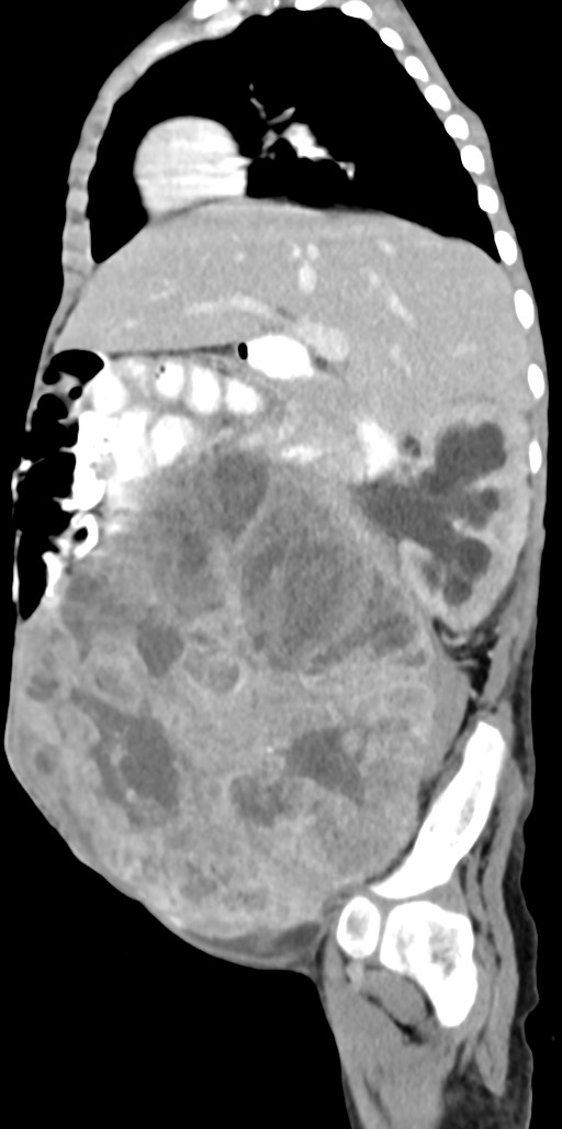 Abdominopelvic rhabdomyosarcoma (Radiopaedia 78356-90984 Sagittal C+ portal venous phase 62).jpg
