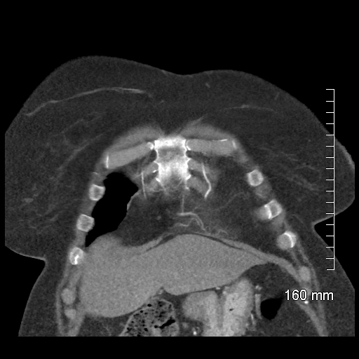 Aberrant right subclavian artery stenosis (Radiopaedia 52656-58670 B 19).jpg