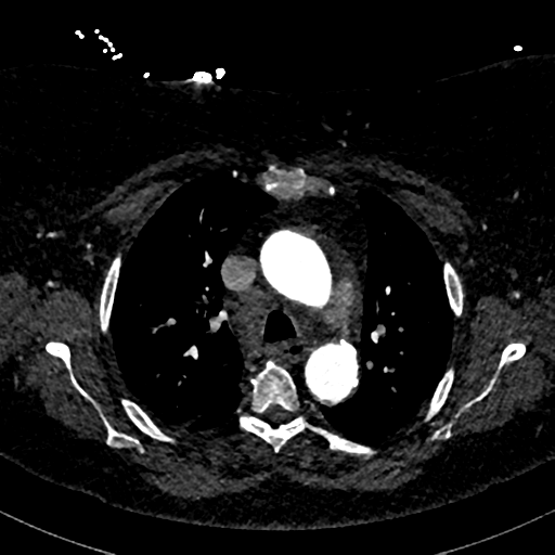 File:Aberrant right subclavian artery with Kommerell diverticulum (Radiopaedia 47982-52769 Axial C+ arterial phase 31).png