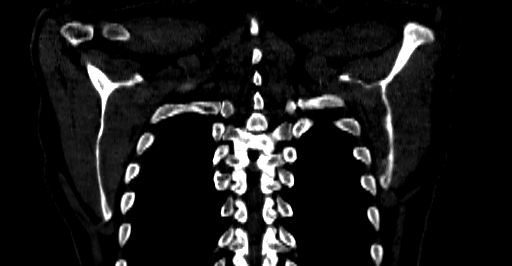 Accesory rib joint (Radiopaedia 71987-82452 Coronal bone window 67).jpg