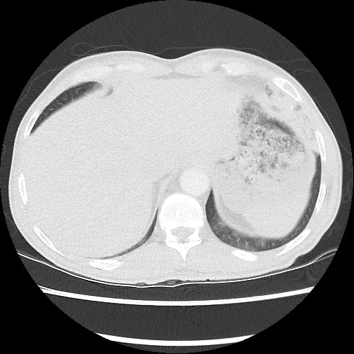 Accessory left horizontal fissure with lingular pneumonia (Radiopaedia 53763-59843 Axial lung window 48).jpg