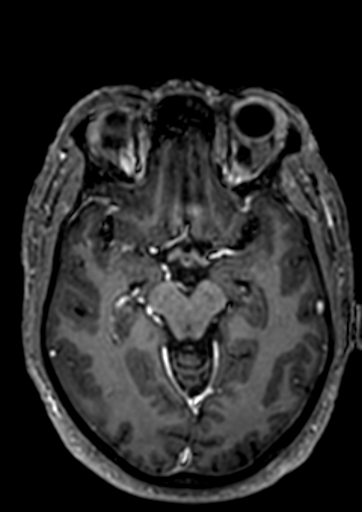 File:Accessory middle cerebral artery (Radiopaedia 73114-83828 Axial T1 C+ 67).jpg