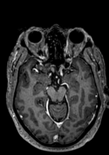 Accessory middle cerebral artery (Radiopaedia 73114-83828 Axial T1 C+ 79).jpg