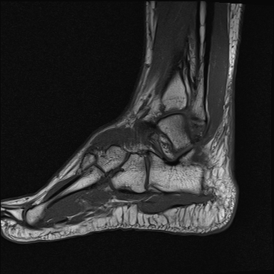 File:Achilles tendon tear (Radiopaedia 77615-89819 Sagittal T1 16).jpg