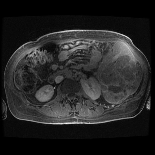 Acinar cell carcinoma of the pancreas (Radiopaedia 75442-86668 Axial late phase (~30 mins) 31).jpg