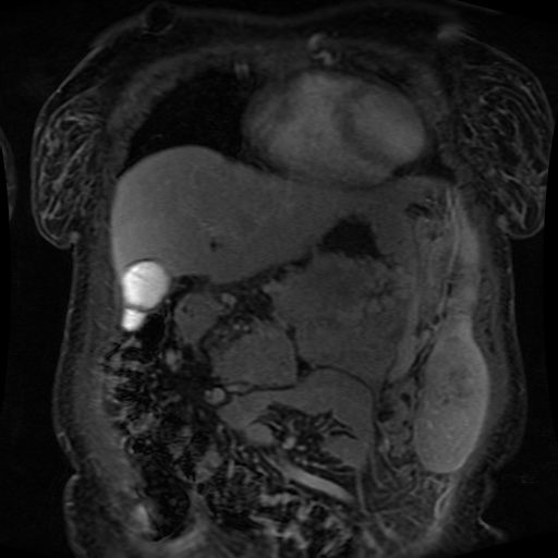 File:Acinar cell carcinoma of the pancreas (Radiopaedia 75442-86668 Coronal T1 C+ fat sat 142).jpg