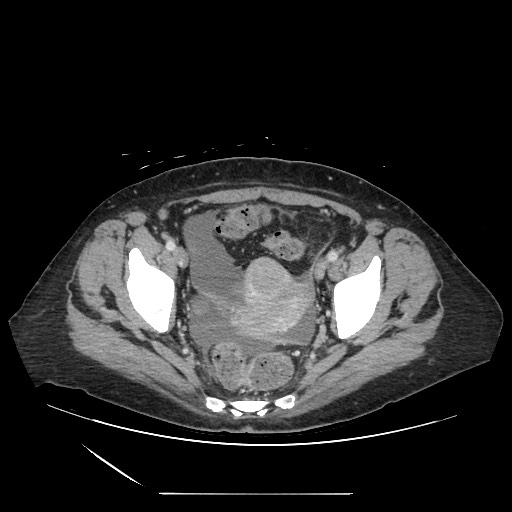 Acinar cell carcinoma of the pancreas (Radiopaedia 75442-86669 Axial C+ portal venous phase 129).jpg