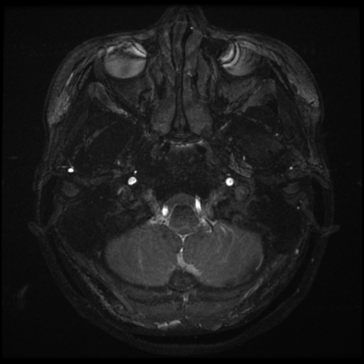 Acoustic neuroma (Radiopaedia 34049-35283 Axial 4).png