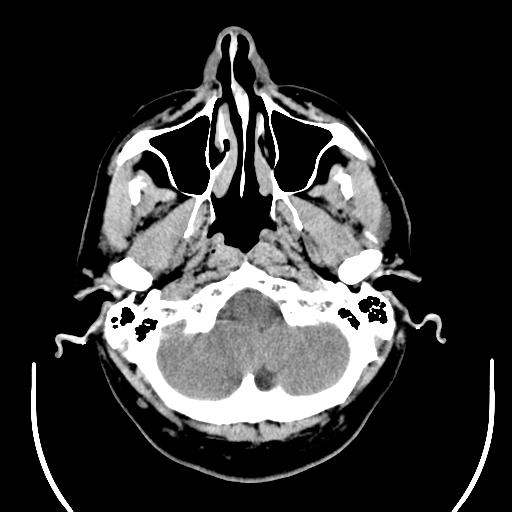 File:Acoustic schwannoma (Radiopaedia 29488-29982 AXIAL THICK non-contrast 6).jpg
