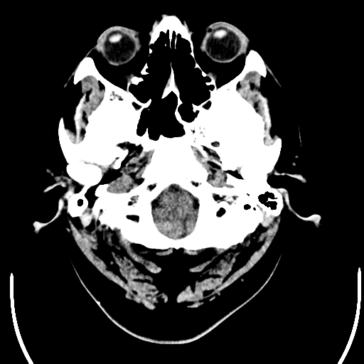 File:Acoustic schwannoma (Radiopaedia 39170-41389 Axial non-contrast 2).png