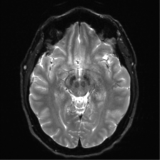 File:Acoustic schwannoma (Radiopaedia 50846-56358 Axial DWI 13).png