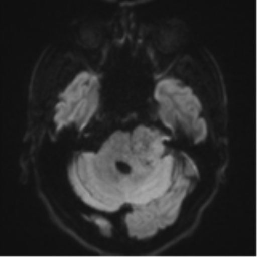 File:Acoustic schwannoma (Radiopaedia 55729-62281 E 33).png
