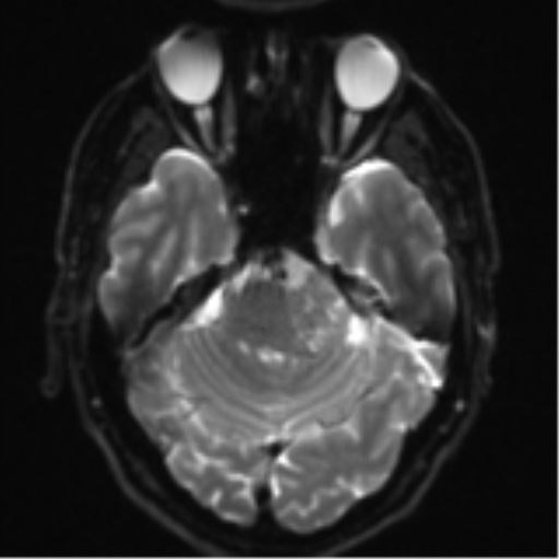 File:Acoustic schwannoma (Radiopaedia 55729-62281 E 7).png