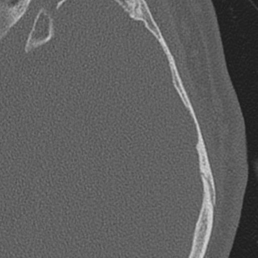 Acoustic schwannoma - cystic (Radiopaedia 29487-29980 AXIAL LEFT bone window 60).jpg