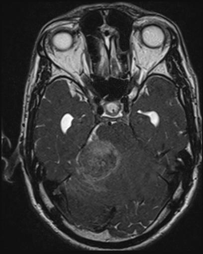 File:Acoustic schwannoma - probable (Radiopaedia 20386-20292 Axial T1 50).jpg