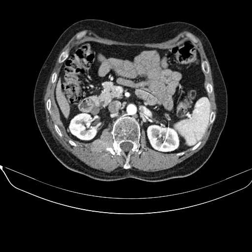 File:Acquired adrenal hyperplasia - due to thymic carcinoid tumor (Radiopaedia 21269-21184 C+ arterial phase 46).jpg