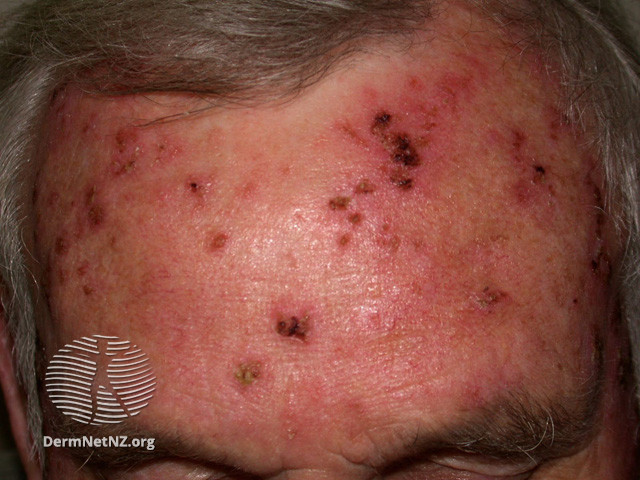 File:Actinic Keratoses treated with imiquimod (DermNet NZ lesions-ak-imiquimod-3735).jpg