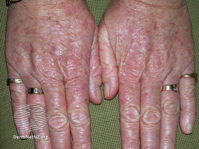 File:Actinic Keratoses treated with imiquimod (DermNet NZ lesions-ak-imiquimod-3752).jpg