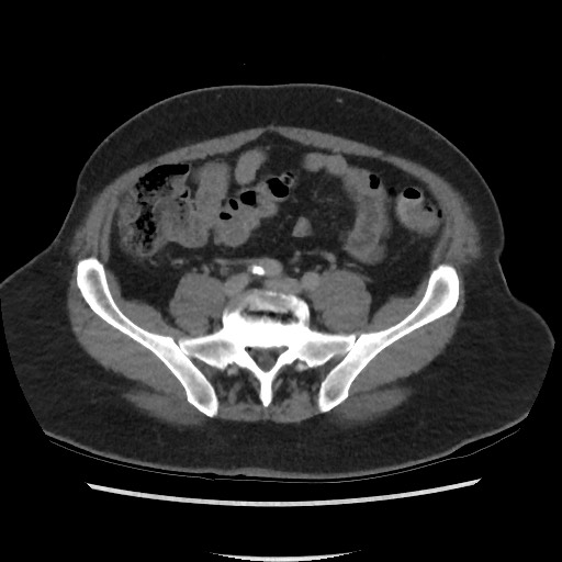 File:Active colonic bleed on CT (Radiopaedia 49765-55025 Axial C+ delayed 58).jpg