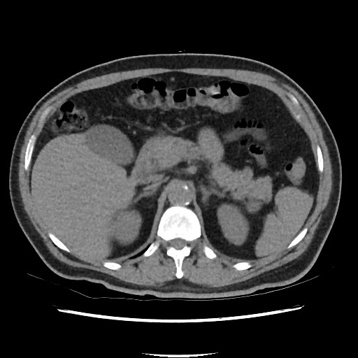 Active colonic bleed on CT (Radiopaedia 49765-55025 Axial non-contrast 22).jpg