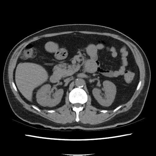 Active colonic bleed on CT (Radiopaedia 49765-55025 Axial non-contrast 29).jpg