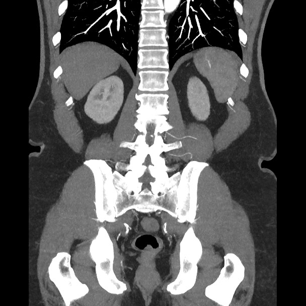Active colonic bleed on CT (Radiopaedia 49765-55025 Coronal art MIP 46).jpg