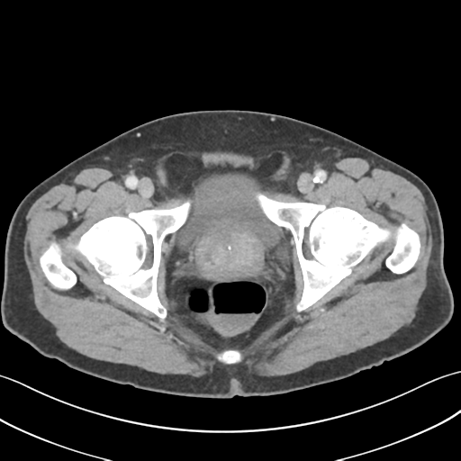 File:Active diverticular hemorrhage (Radiopaedia 39415-41725 Axial C+ portal venous phase 68).png