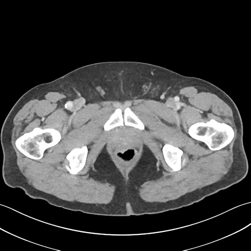 File:Active diverticular hemorrhage (Radiopaedia 39415-41725 Axial C+ portal venous phase 74).png