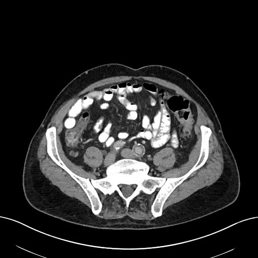 File:Active lower gastrointestinal bleeding - diverticular (Radiopaedia 61203-69106 Axial C+ portal venous phase 88).jpg