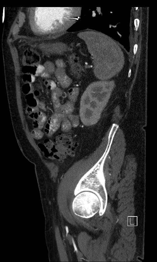 Active lower gastrointestinal bleeding - diverticular (Radiopaedia 61203-69106 Sagittal C+ arterial phase 38).jpg