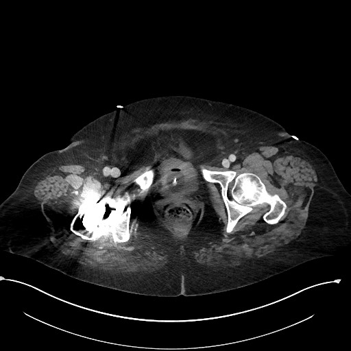 File:Active renal extravasation with large subcapsular and retroperitoneal hemorrhage (Radiopaedia 60975-68796 Axial 328).jpg