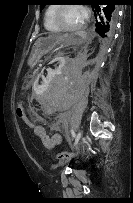Active renal extravasation with large subcapsular and retroperitoneal hemorrhage (Radiopaedia 60975-68796 Sagittal C+ portal venous phase 91).jpg